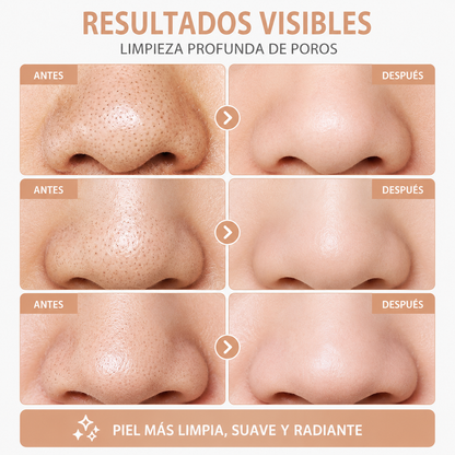 Limpiador facial de poros - Extractor de puntos negros con 5 niveles de succión.